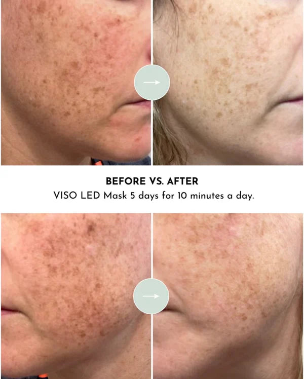 Viso - Red Light Therapy - Age-Defying Mask